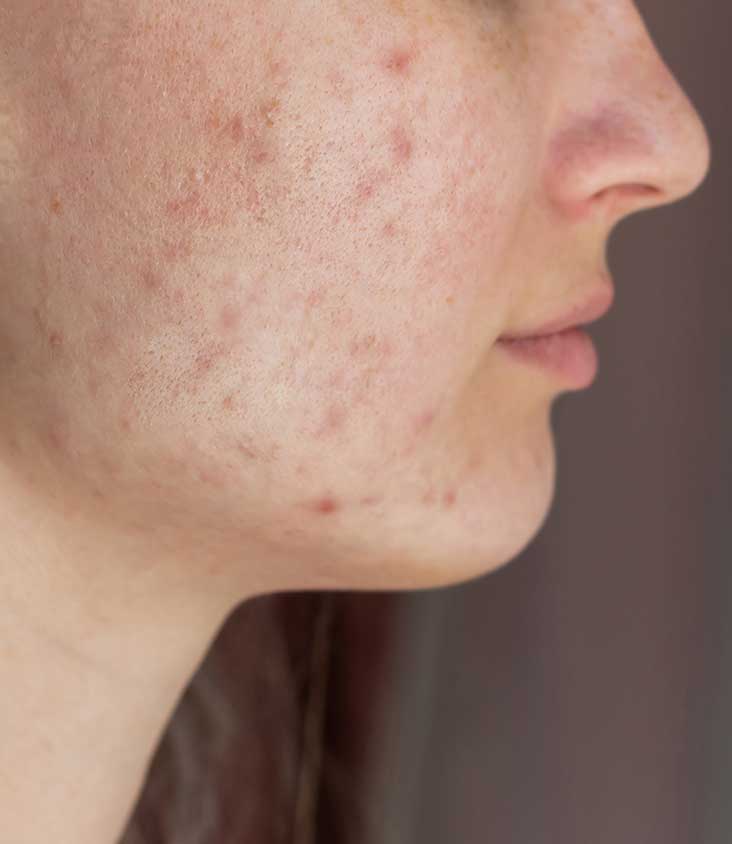 rash-before rash-before